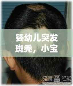 婴幼儿突发斑秃,小宝宝斑秃